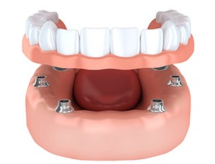 Render of implant dentures in Greenfield, WI for lower arch