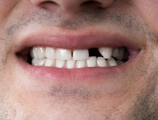 Man showing space where a tooth once existed