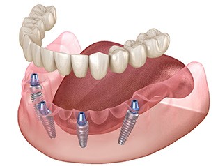 Illustration of lower arch of implant dentures with white background
