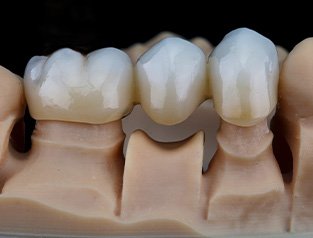 A custom-made dental bridge on a mouth mold