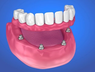 all-on-4 denture