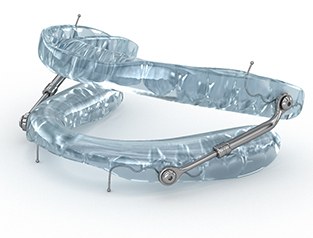 Close up of oral appliance used to treat sleep apnea