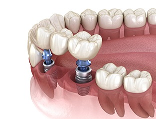 Illustration showing implant bridge replacing missing teeth 