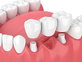 Illustration of a dental bridge