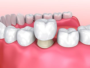 crown over tooth