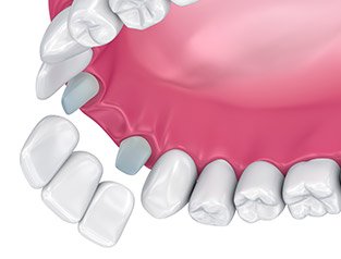 bridge illustration on teeth