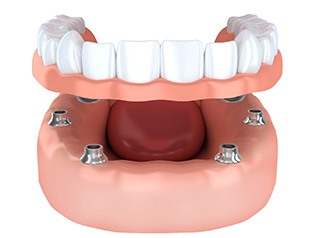 Render of implant dentures in Greenfield, WI for lower arch