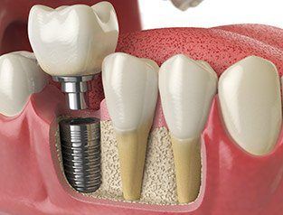 A diagram of an integrated dental implant