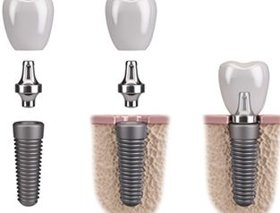 The parts of a dental implant