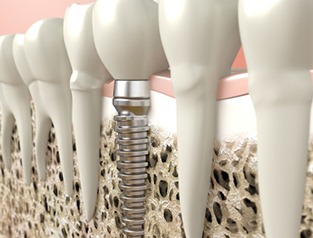 A diagram of a dental implant