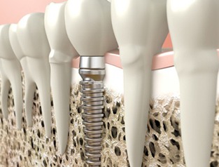 A diagram of a dental implant