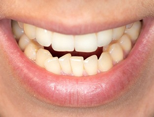 Closeup of patient with crowded teeth before getting Invisalign