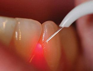 laser being used on gums