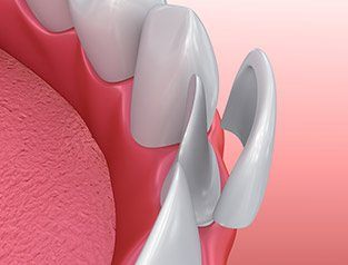 illustration of porcelain veneers