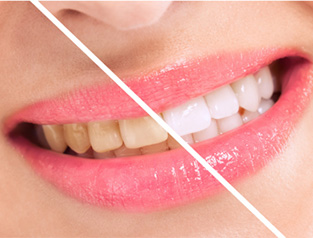  before and after whitening