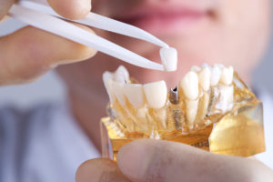 Dental implants in Greenfield can change a patient's life for the better. 