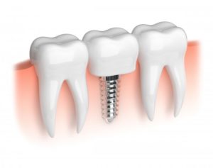 Illustration of a dental implant