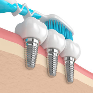 Toothbrush cleaning dental implants
