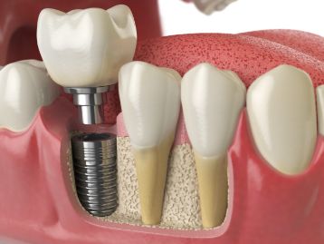 3D image of a single dental implant in lower jawbone