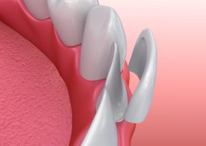 Model of teeth and veneers in Greenfield.