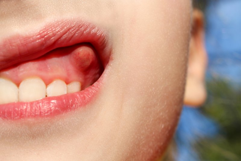 Person with a bump on their gums