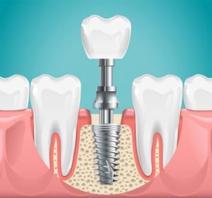 Image of a dental implant.