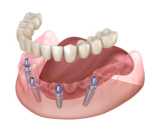 Render of All-on-4 dentures for the lower arch