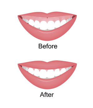 Illustration of smile before and after gum recontouring