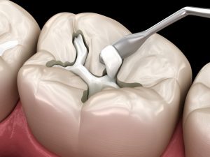 a digital illustration of a tooth being filled