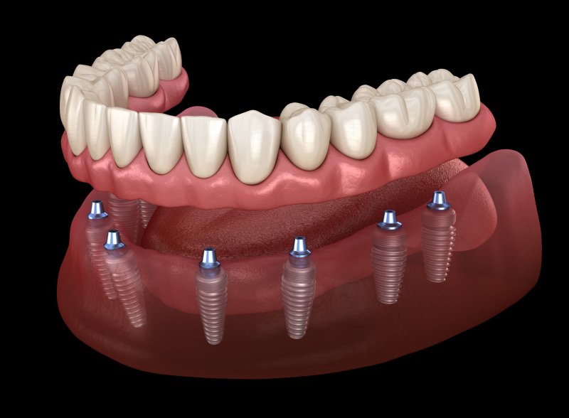 3D render of implant dentures