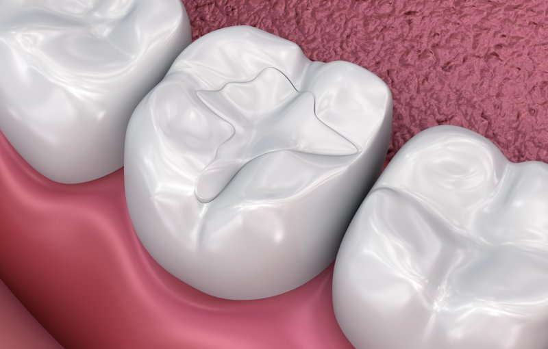 A 3D illustration of tooth-colored dental fillings