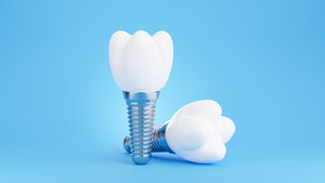 3D render of a dental implant