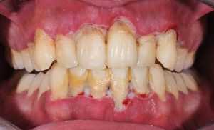 Close up of patient’s mouth with advanced gum disease